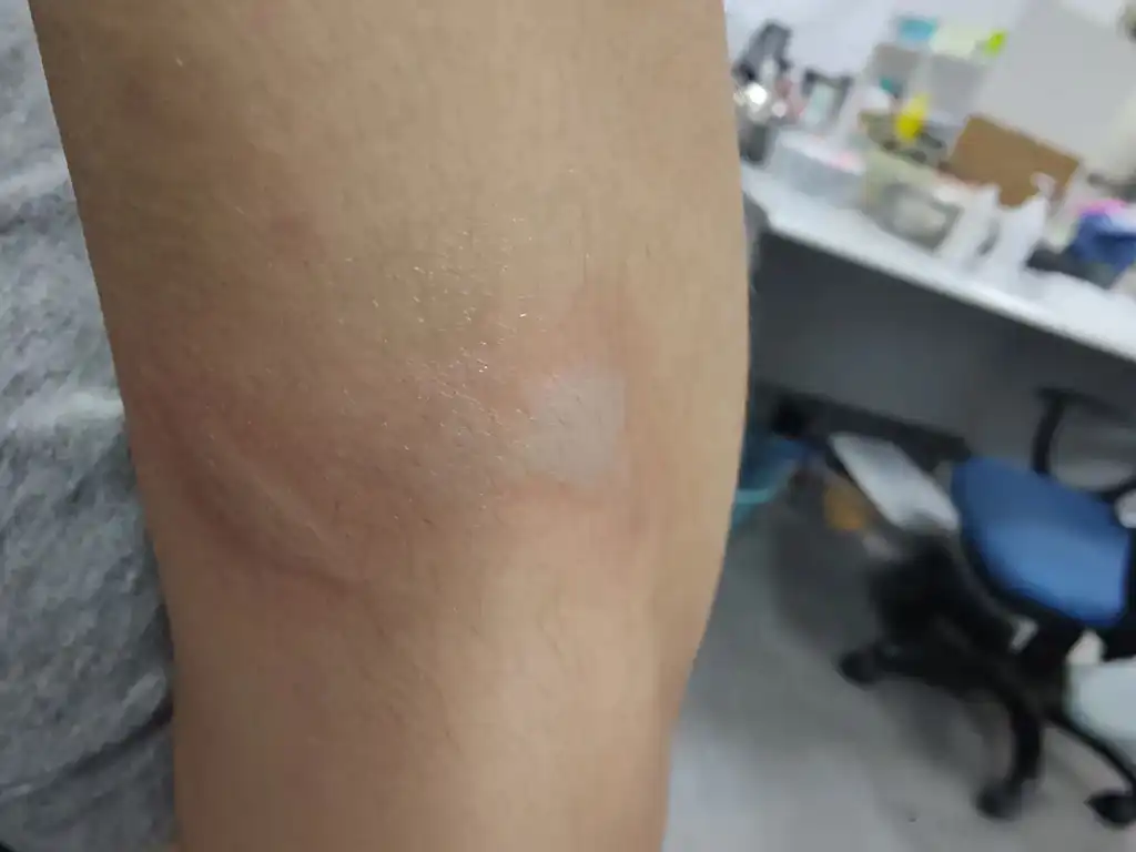 Chemical Exposure  Caused Blister