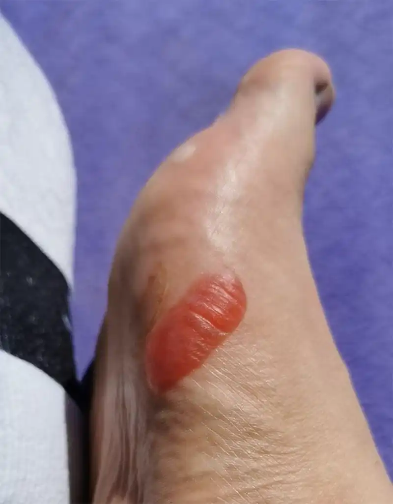 Foot Blisters in Athletes