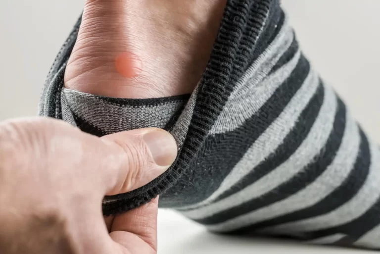 What Are Foot Blisters? Understanding Causes, Symptoms, and Treatment Options