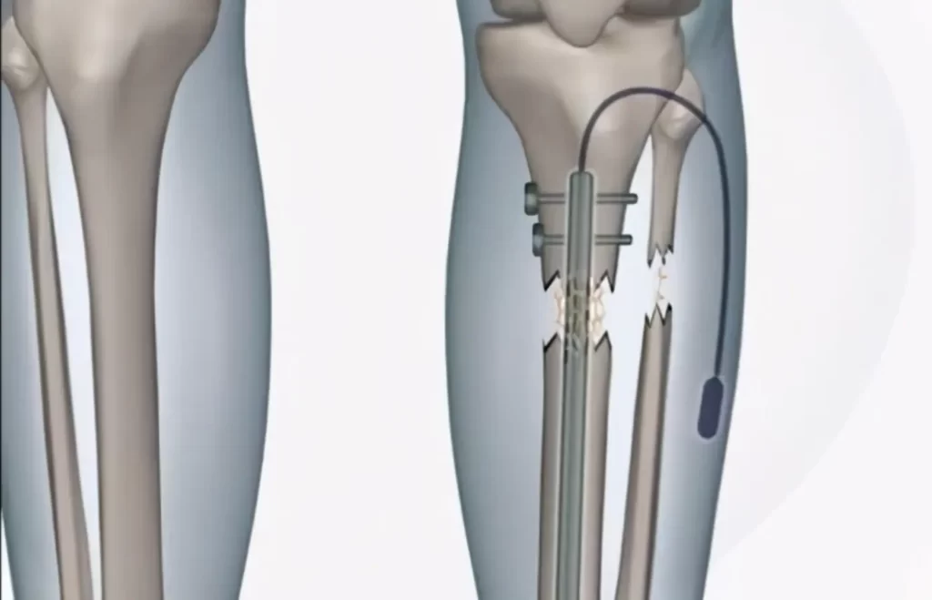 surgery to shrink height